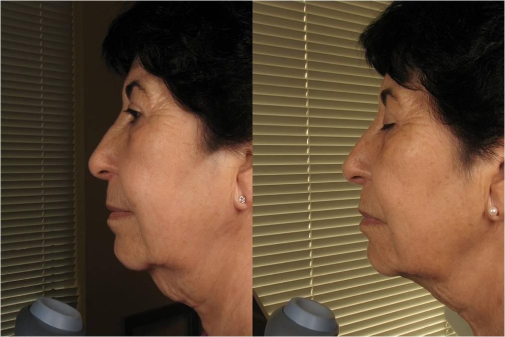 Lifting sans chirurgie Longueuil