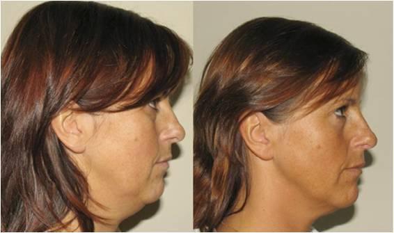 Laval facial treatment